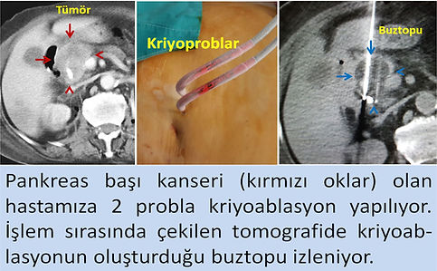 Kriyoablasyon pankreas kanserinde hem tümörü öldürebilir hem de ağrıyı giderebilir.