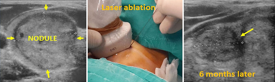 Large thyroid nodules causing goiter can be nonsurgically treated with laser ablation.