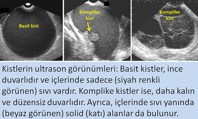 Basit kistler ve komplike kistlerin ultrason görünümleri.