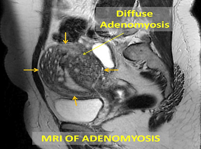 DIFFUSE ADENOMYOSIS