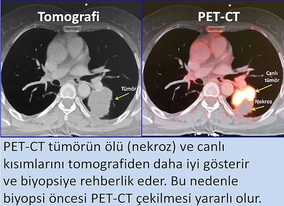 akciger kanserinde girisimsel tedaviler