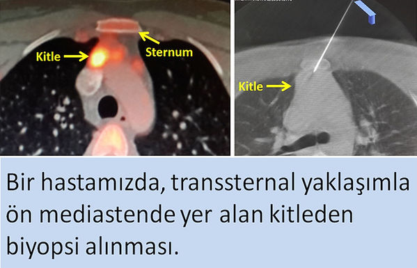 Mediastinal biyopsi, transsternal yaklaşım.
