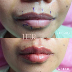 Lip Fillers