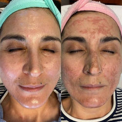 C02 Fractional Laser