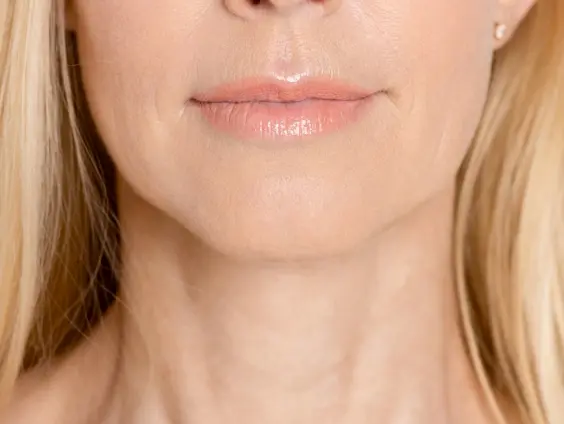 kybella-1.webp