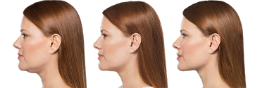 kybella.webp