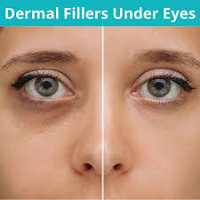 Under Eye Filler Help Dark Circles?