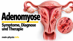 Adenomyose: 3D-Anatomie einer Gebärmutter mit verdickter Muskelschicht und Adenomyoseherden