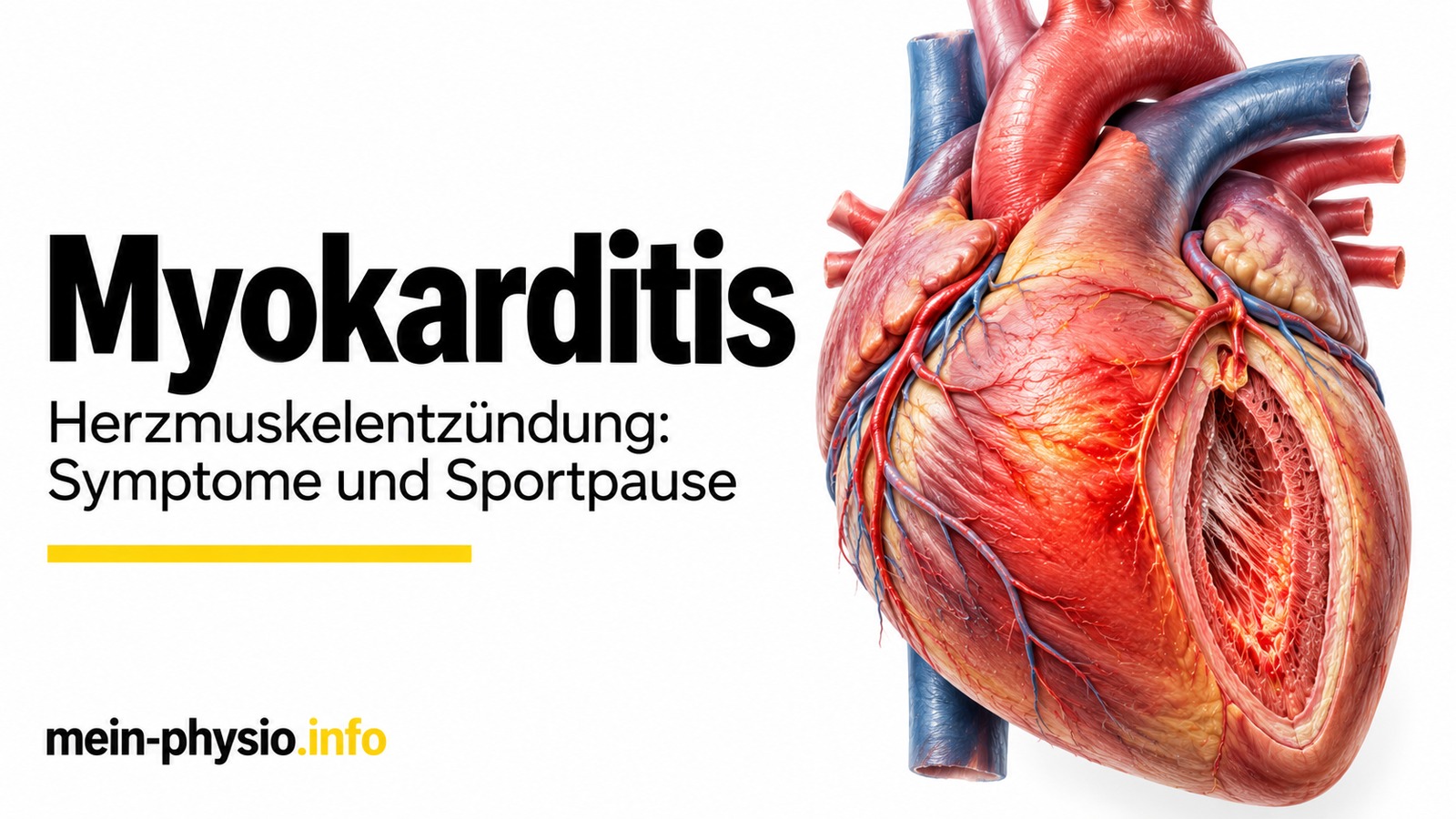 Myokarditis: anatomische Darstellung eines entzündeten Herzmuskels mit hervorgehobenen Herzwandstrukturen
