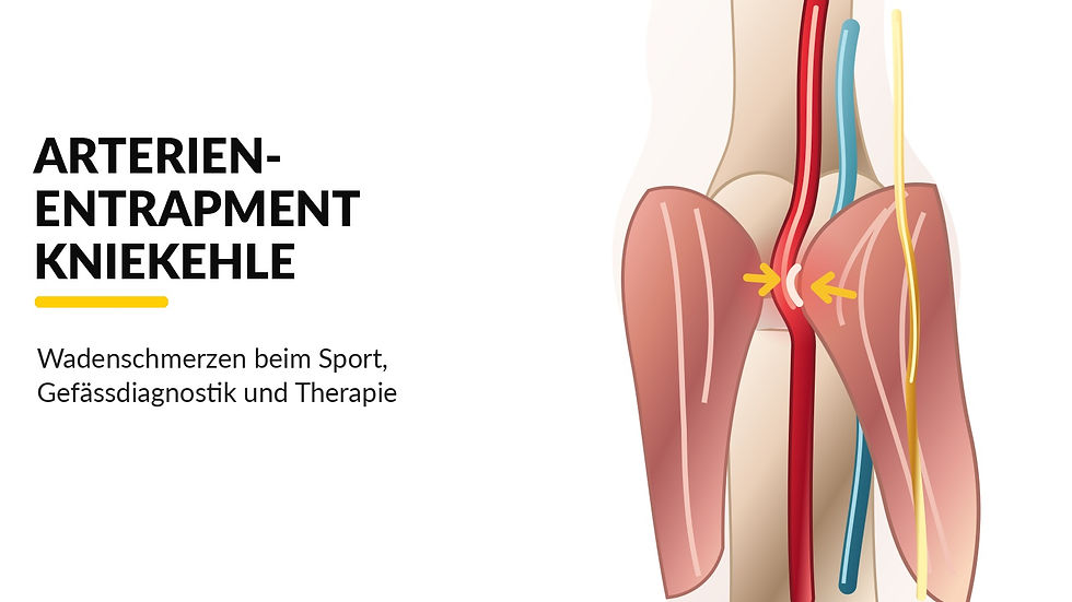 PAES – schematische anatomische Darstellung der Kniekehlenarterie, die zwischen Wadenmuskeln komprimiert wird