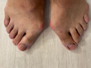 Hallux Valgus: Ursache, Symptome und Behandlung | schmerzcenter.com