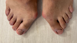 Hallux Valgus: Ursache, Symptome und Behandlung | schmerzcenter.com