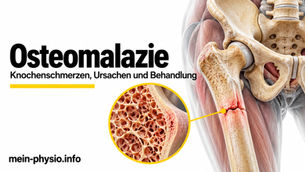 Osteomalazie: 3D-Modell von Becken und Oberschenkel mit unzureichend mineralisiertem Knochen, Mein Physio