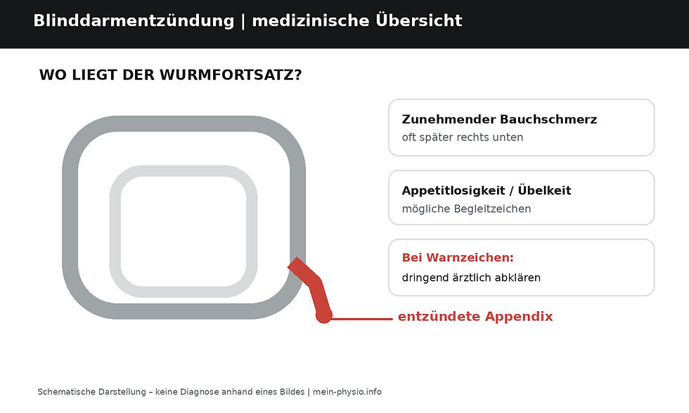 Mein Physio – Blinddarmentzündung – schematische medizinische Darstellung