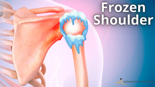 Frozen Shoulder: Ursache, Symptome und Behandlung | schmerzcenter.com