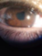 Uveitis