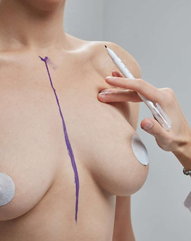 doctor-hand-drawing-lines-on-woman-breast-breast-implant-surgery-concept--qsk5c6lkdejsxyvi
