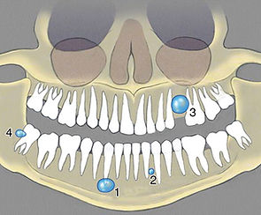Illustration of a jaw cyst and its surgical removal procedure. oran ankara türkiye