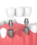 Close-up of mini dental implants designed for smaller bone structures.