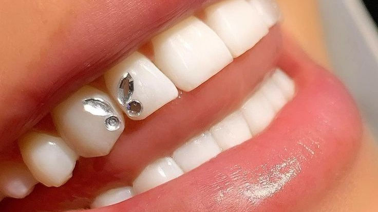 Lächeln mit einem glitzernden Zahnschmuckstein auf dem Frontzahn