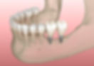 Diagram showing how mini implants stabilize dentures for better oral function.