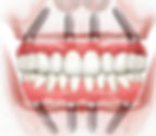 All-on-4 dental implants diagram showing implant placement and prosthetic teeth.