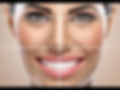 Same-day dental prosthesis placed on digitally guided implants.