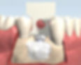 Chin bone powder application in a dental implant surgery illustration.