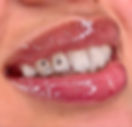 Close-up of a tooth gem being applied by a dentist for a sparkling smile. swarovski Tooth Gems