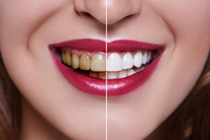 Professional Teeth Whitening at Funda Sarıkaya Dental Clinic in Oran, Çankaya, Ankara – Achieve a Brighter Smile