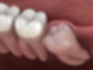 wisdom teeth 2.jpeg
