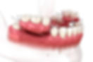 Dentist demonstrating the placement of partial dentures on a dental model.