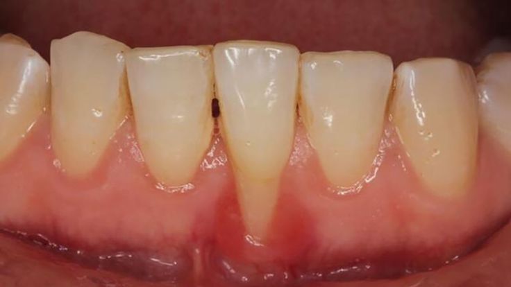 Diagram showing gum recession and exposed tooth roots.