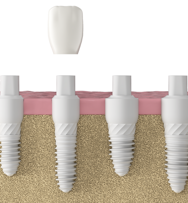 steinsohn Meridian dental implant