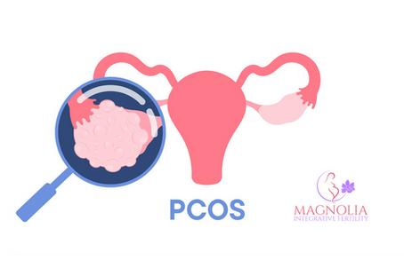 Magnifying glass looking at a polycystic ovary