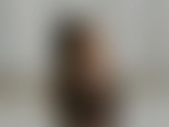 Understanding KYBELLA: A Treatment for Double Chin Reduction