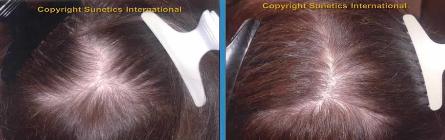 Female, 51 years old-After 12 Months