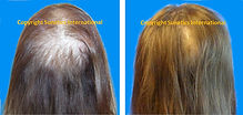sunetics results | female before and after