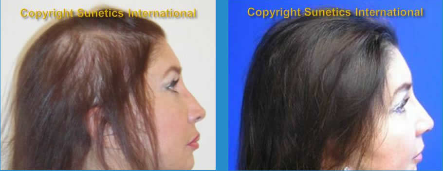 Female, 56 years old –After 6 Months