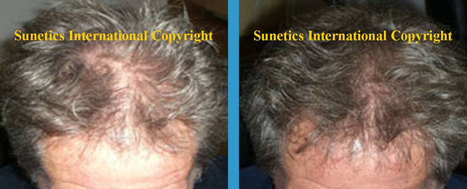 Male, 47 years old - After 4 Months
