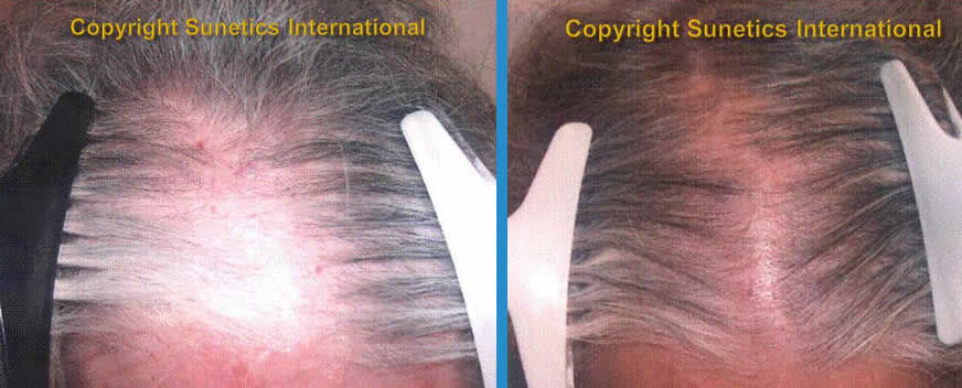 Female, 63 years old -After 6 Months