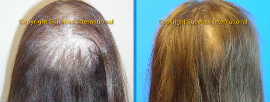 Female, 56 years old -After 8 Months