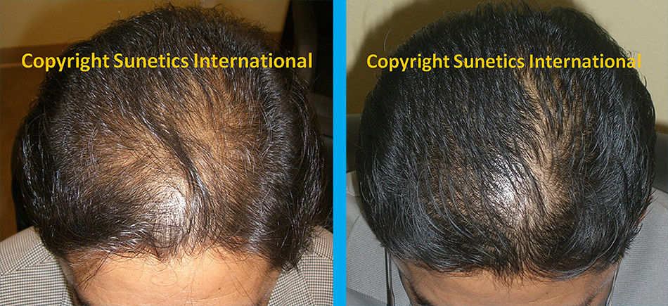 Male, 42 years old - After 2 Months