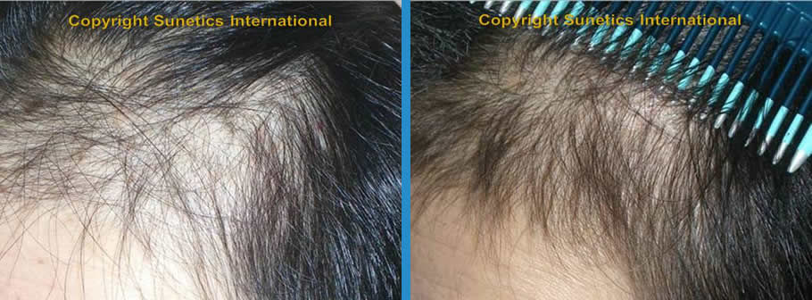 Female, 54 years old -After 4 Months