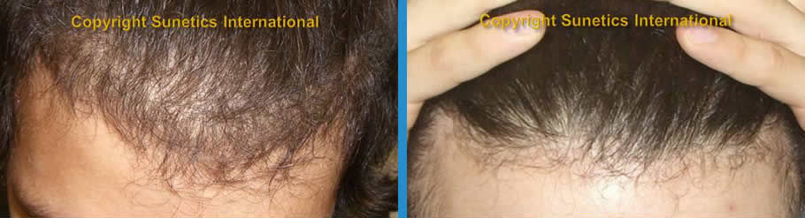 Male, 18 years old - After 6 Months