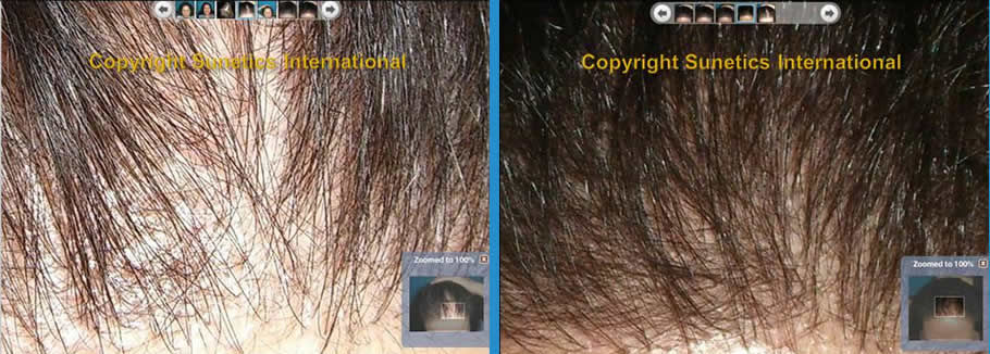 Female, 62 years old -After 6 Months