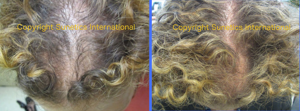 Female, 41 years old- After 6 Months