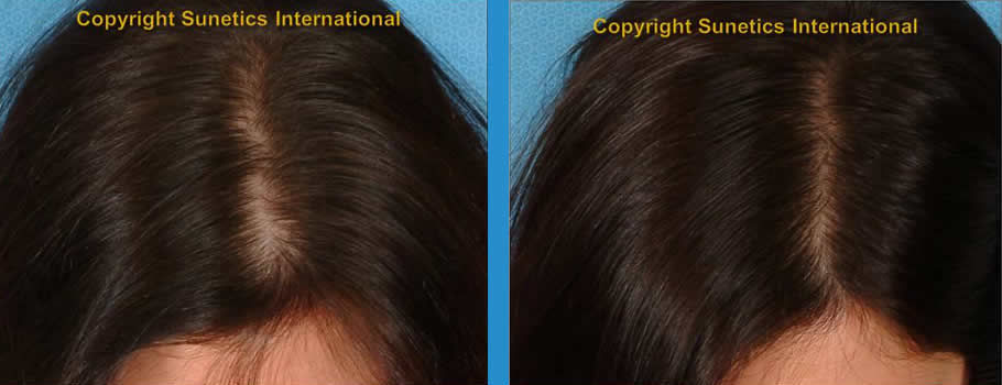 Female, 31 years old-After 2.5 Month