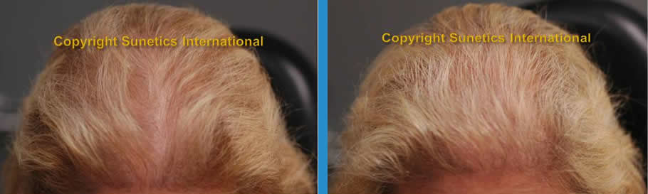 Female, 63 years old -After 3 Months