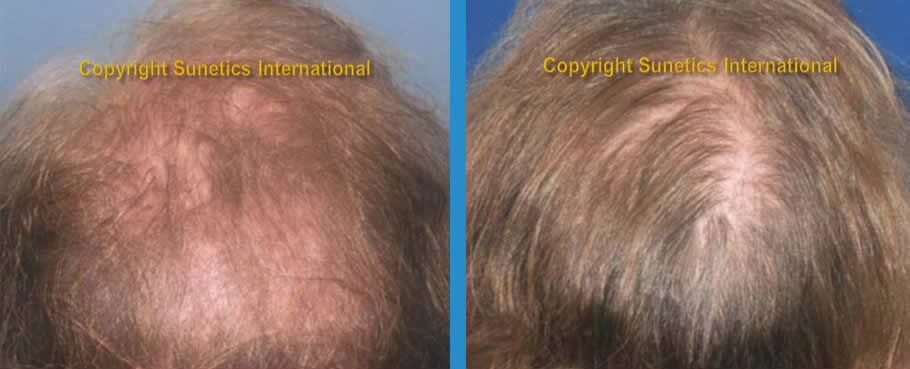 Female, 49 years old -After 6 Months